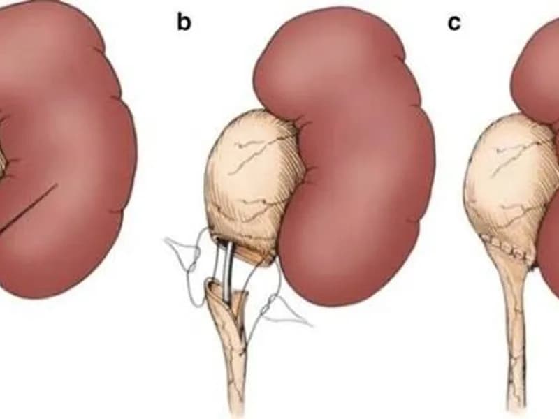 Female Pyeloplasty Surgery in Dhanbad
