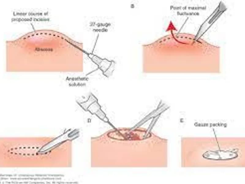 Female Incision and Drainage Surgery in Dhanbad