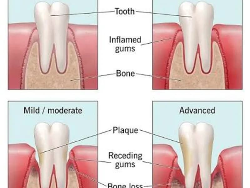 Gum Disease (Periodontal Disease): Causes, Stages, Treatment & Prevention