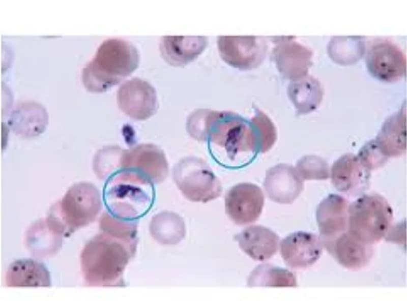 Peripheral Blood Smear for Malaria: Diagnosis and Importance