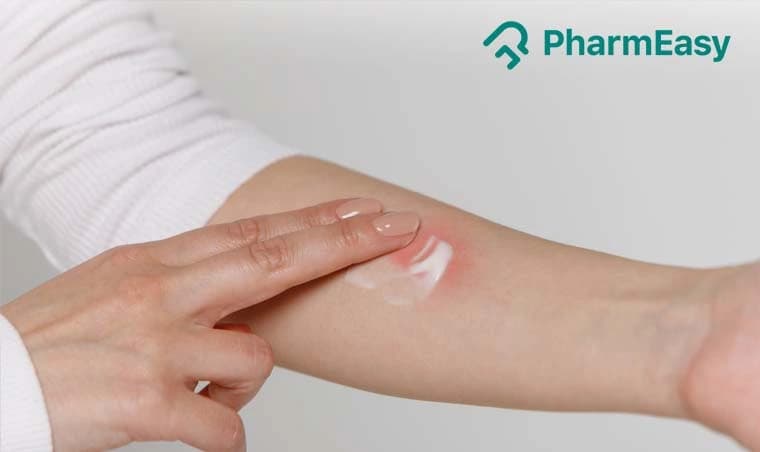 Mosquito Bite Home Remedies: Dr. Gupta's Expert Advice