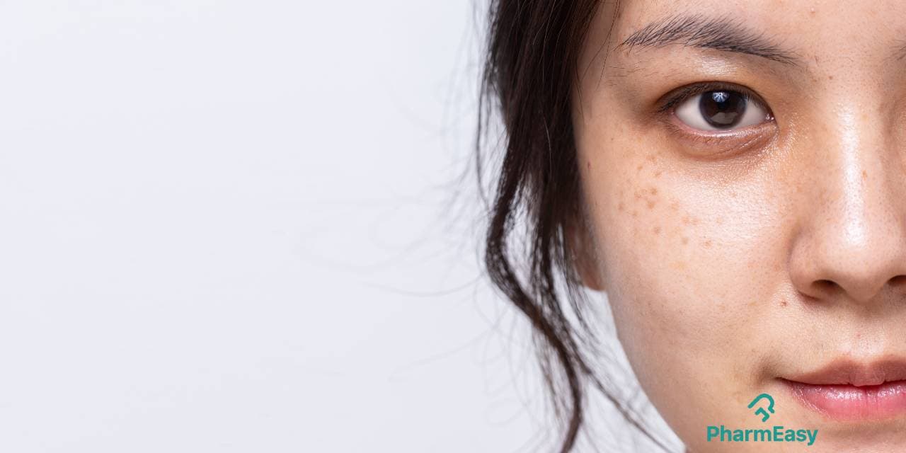 10 Home Remedies for Freckles & Clear Skin