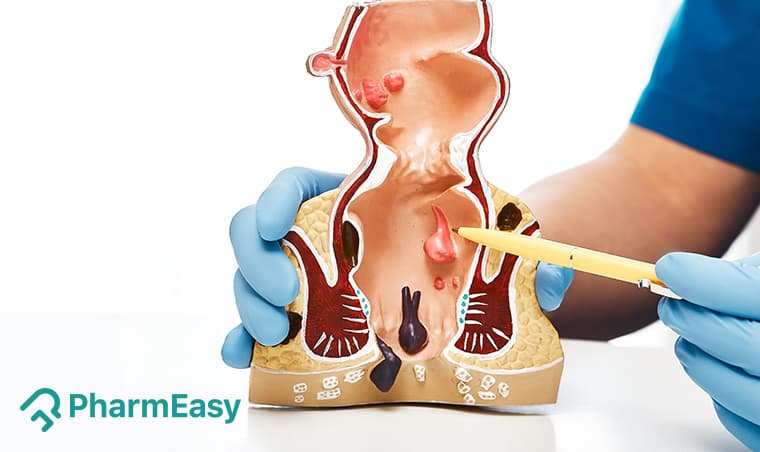 Anal Fissure Home Remedies: Relief & Prevention Tips