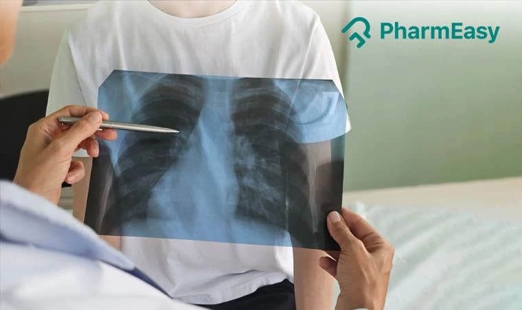 Lobar Pneumonia: Causes, Symptoms, and Treatment in India