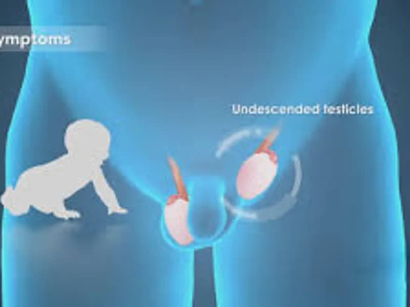 Child Undescended Testis Bilateral Surgery in Deoghar