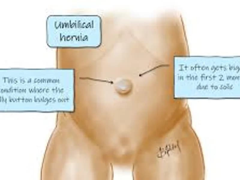 Child Umbilical Hernia Repair Surgery in Deoghar