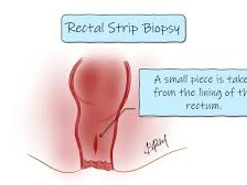 Child Rectal Biopsy Surgery in Deoghar