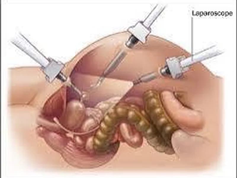 Female Diagnostic Laparoscopy Surgery in Deoghar