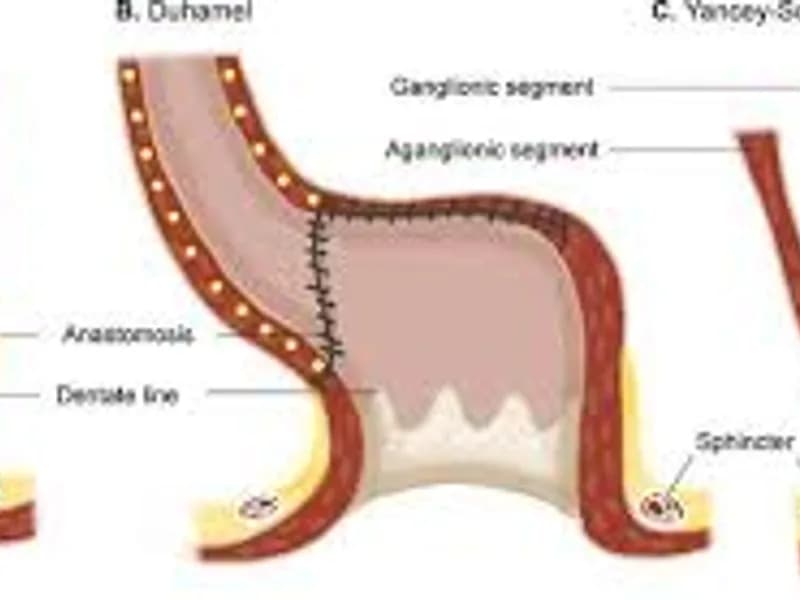 Abdominal Perineal Pull Through Hirschsprung Disease Surgery in Deoghar | Cost, Best Surgeons & Treatment Guide