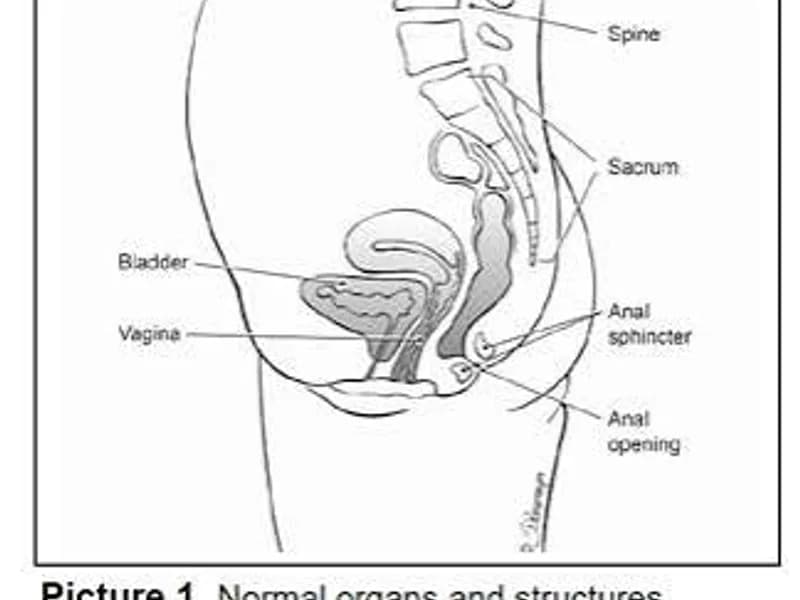 Female Imperforate Anus Low Anomaly Perineal Anoplasty in Deoghar