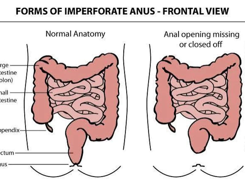 Female Imperforate Anus High Anomaly Closure of Colostomy in Deoghar