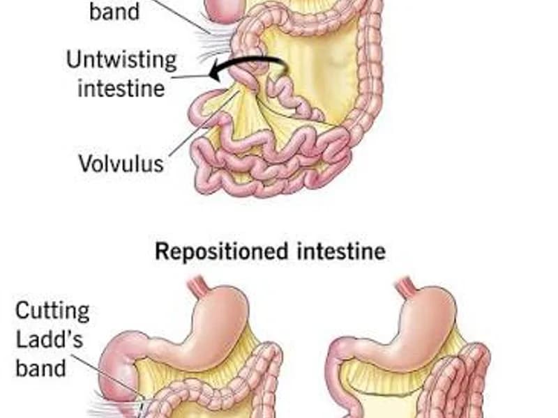 Female Malrotation of Gut Surgery in Deoghar | Top Surgeons