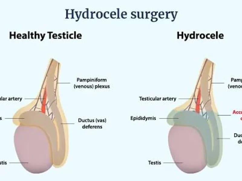 Female Hydrocele of Cord Surgery in Ranchi