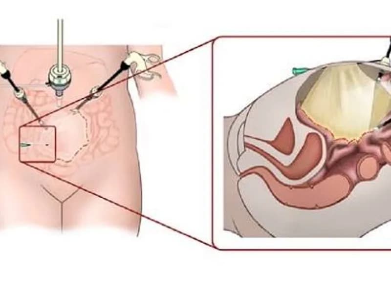 Female Excision of Mesenteric Cyst Surgery in Ranchi