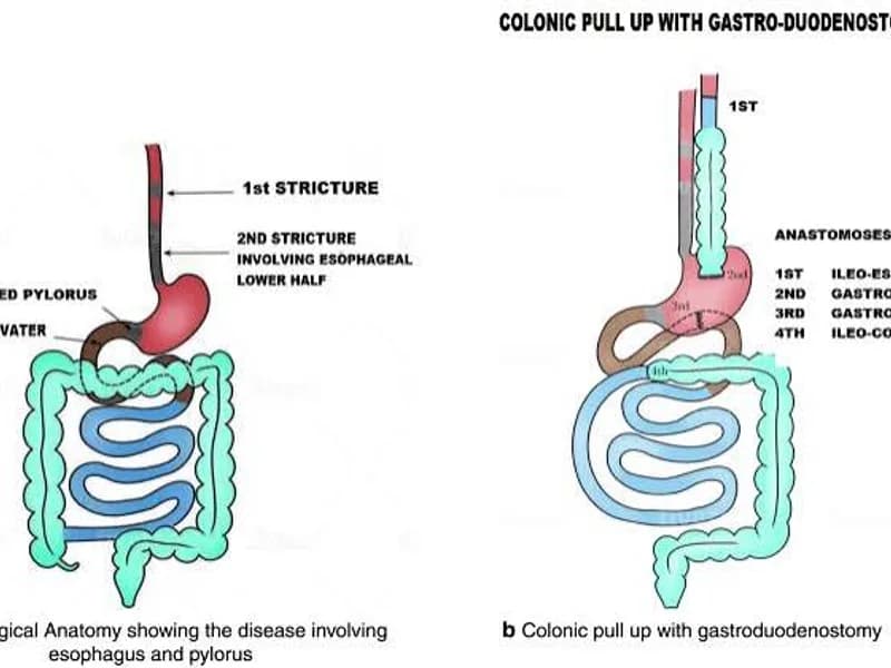 Female Colon Replacement of Esophagus Surgery in Ranchi