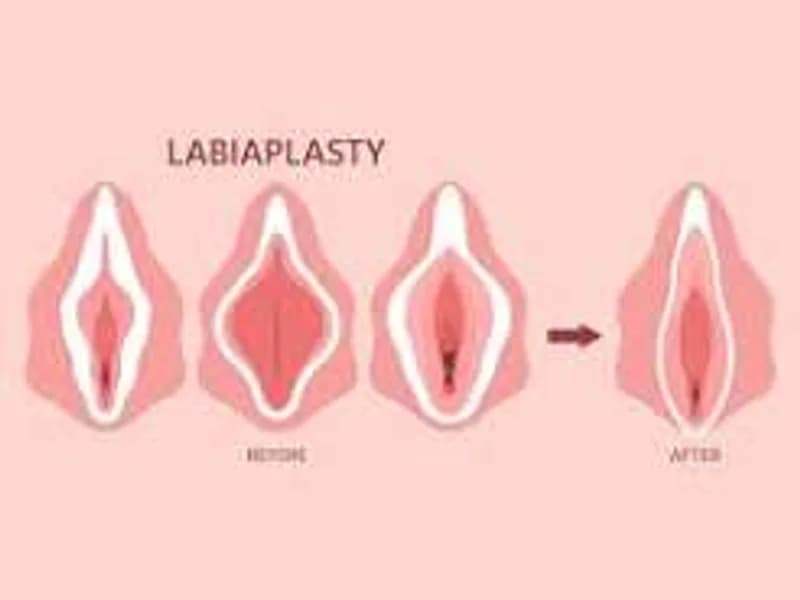 Female Labiaplasty Surgery in Dhanbad