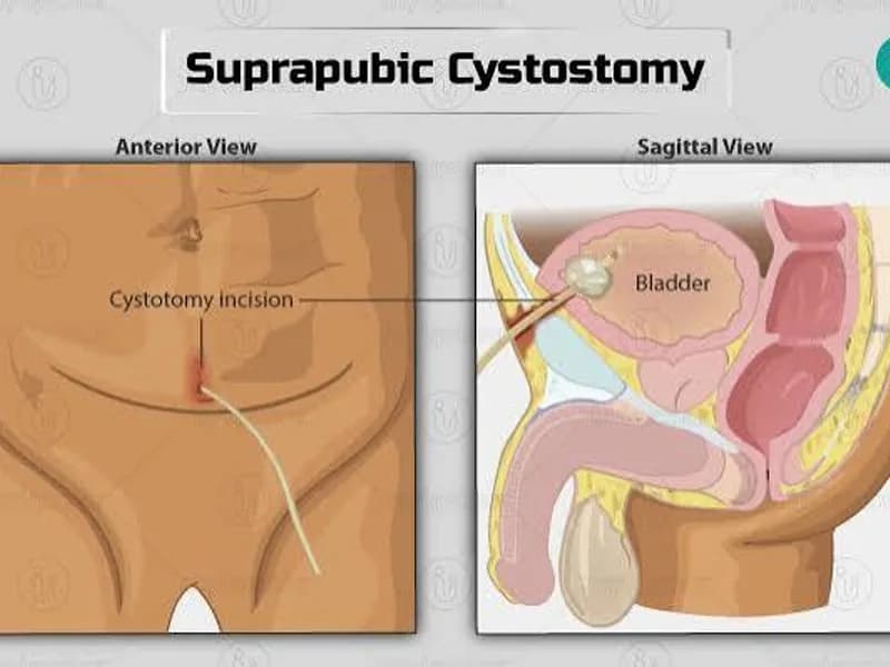 Female Vesicostomy Surgery in Dhanbad