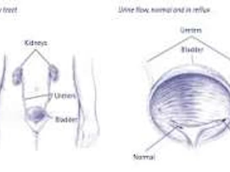 Female Ureteral Reimplantation Surgery for VUR in Dhanbad