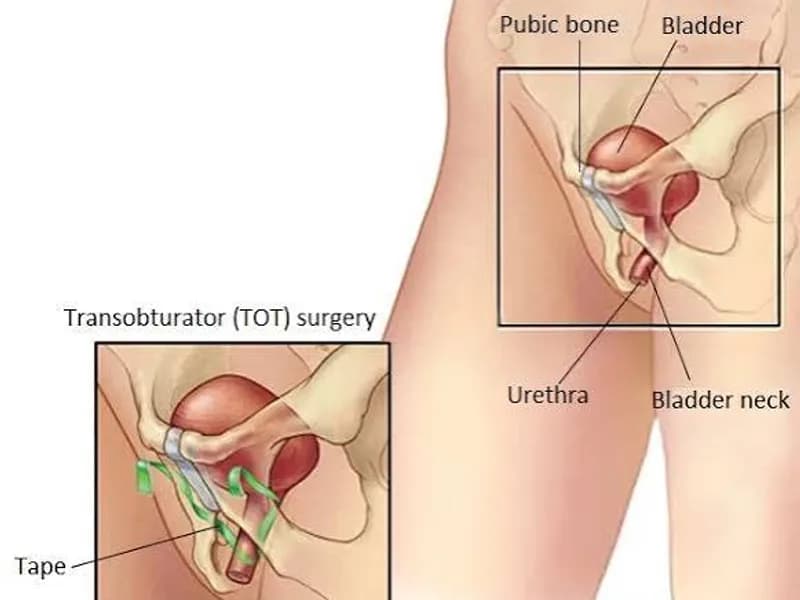 Female TOT Surgery for Stress Incontinence in Dhanbad