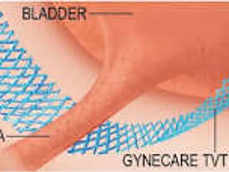 Female TVT Bladder Sling Surgery in Dhanbad