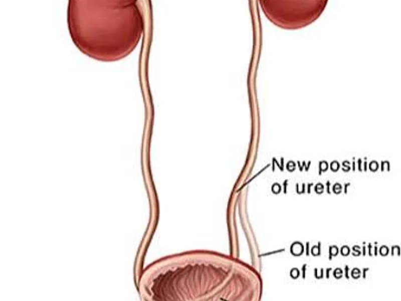 Female Ureteric Reimplantation Bilateral Surgery in Dhanbad